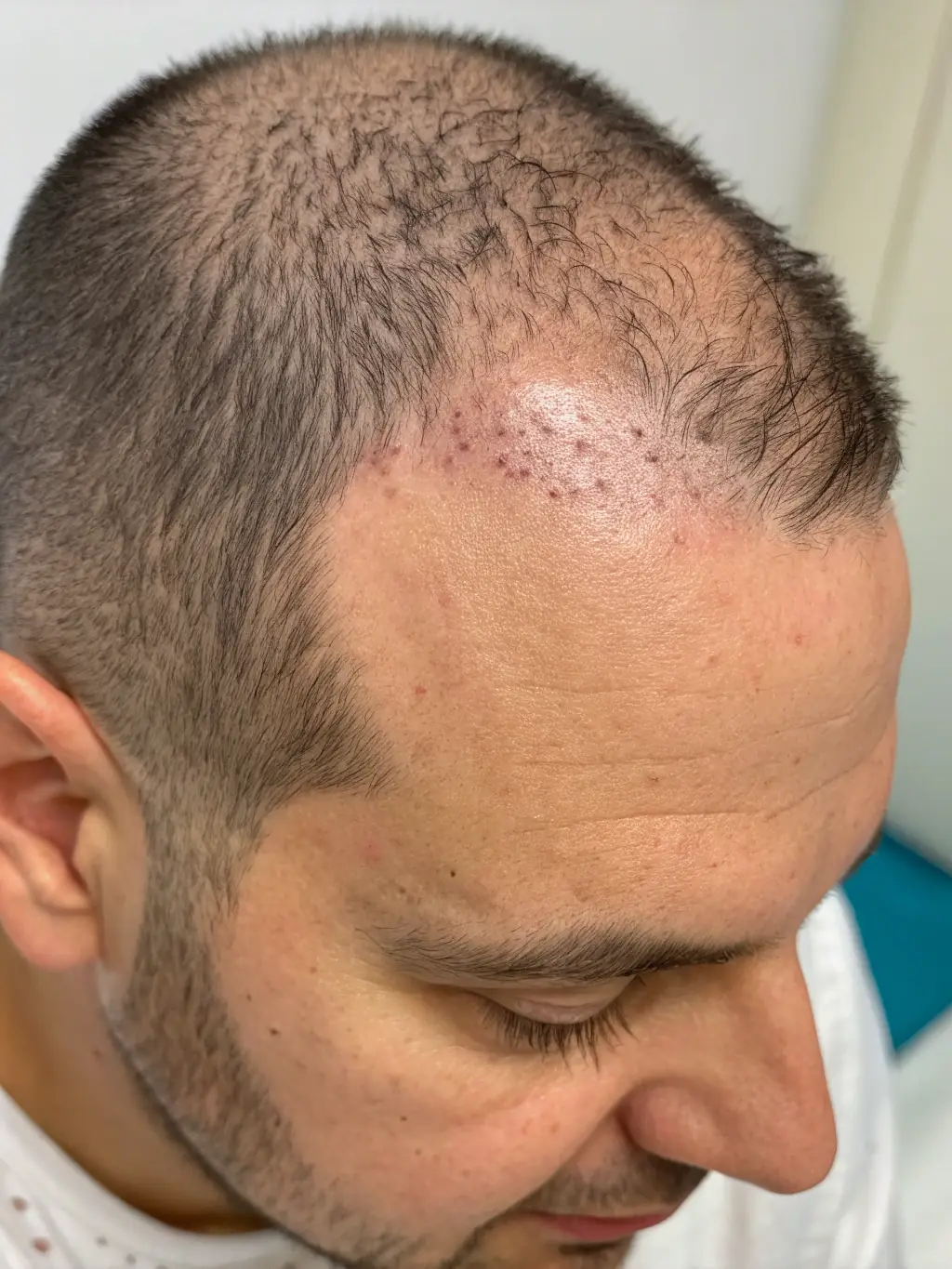 A before-and-after photo demonstrating successful hair regrowth after PRP therapy at Dr. Kiran's Aesthetic Studio, highlighting improved hair density and scalp health.